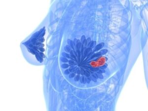Breast Cancer