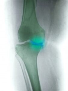 Acupuncture for Rheumatoid Arthritis