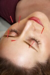 Acupuncture for Sinus