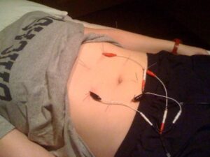 Acupuncture for Weight Loss