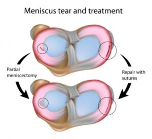 Acupuncture can repair meniscal tears