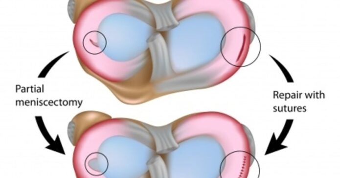 Acupuncture can repair meniscal tears