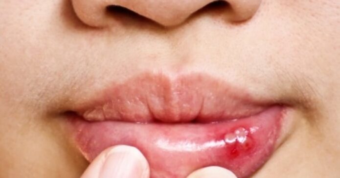 Acupuncture can help with mouth ulcers