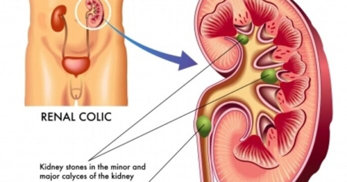 Renal colic