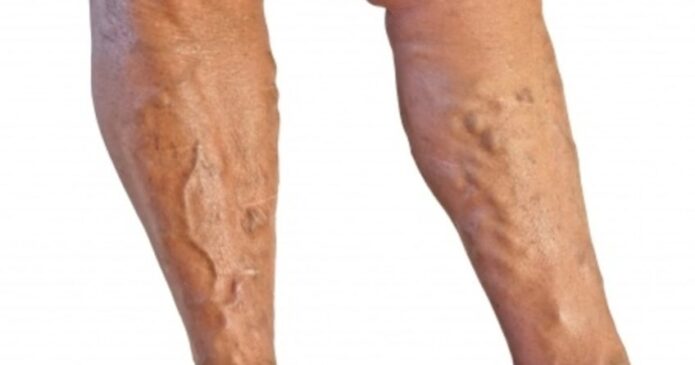 Acupuncture can treat varicose veins