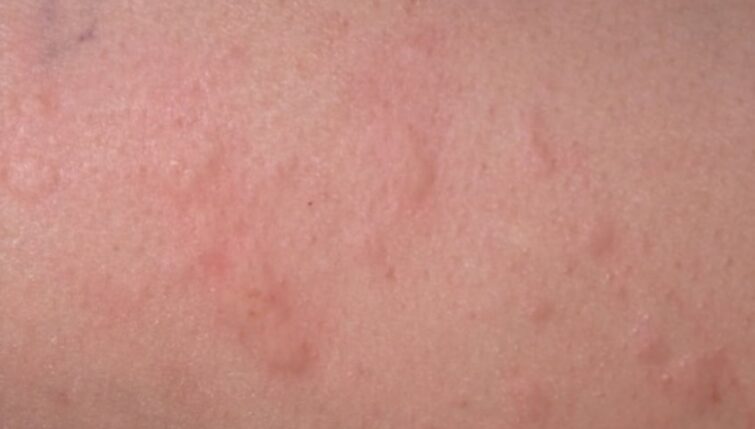 Acupuncture For Allergic Urticaria Hives The Acupuncture Clinic