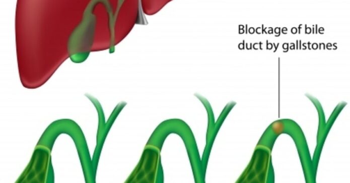 Acupuncture can help gallbladder disease