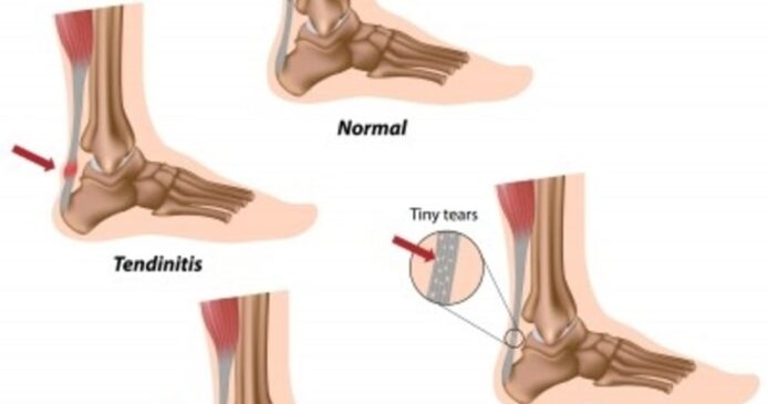 Achilles Tendon Problems