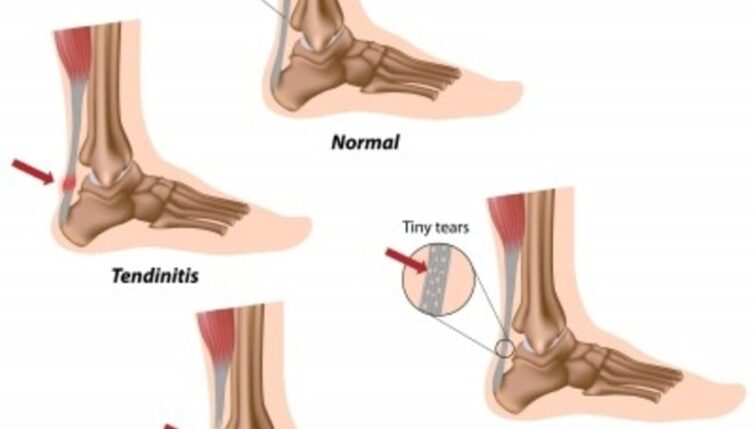 Achilles Tendon Problems