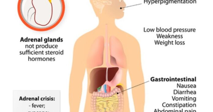 Acupuncture can help for Addison's Disease