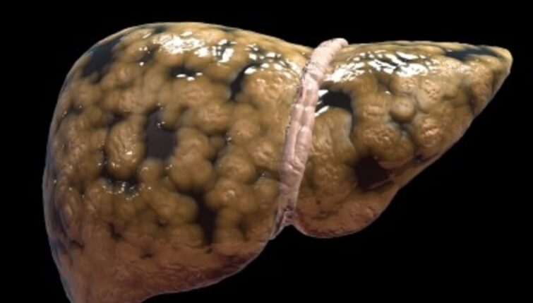 Acupuncture for Liver Disease