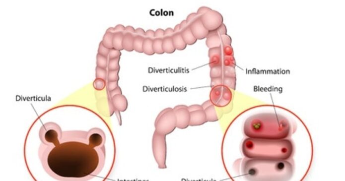 Chinese herbs and acupuncture can help for diverticulitis