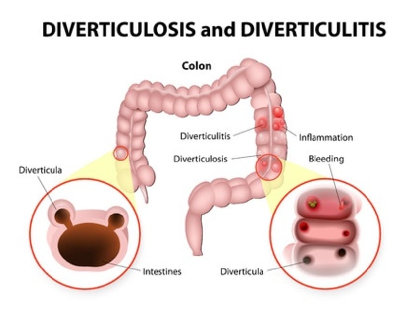 Chinese Herbs and Acupuncture for Diverticulitis The Acupuncture Clinic