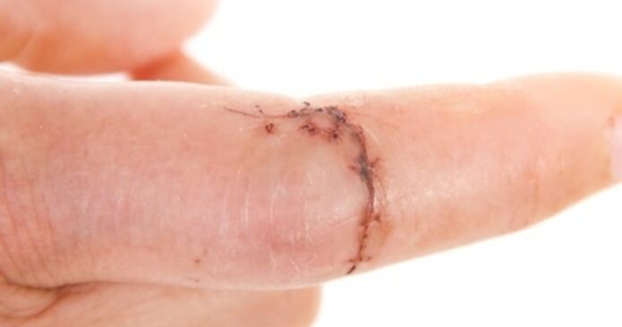 Acupuncture is used for post-operative surgery scarring