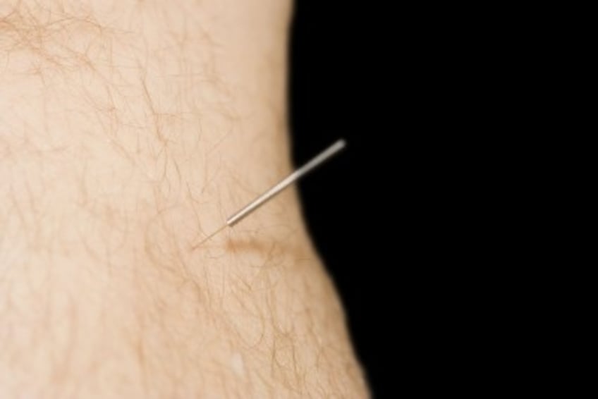 Best Acupuncture Point for Weight Loss The Acupuncture Clinic