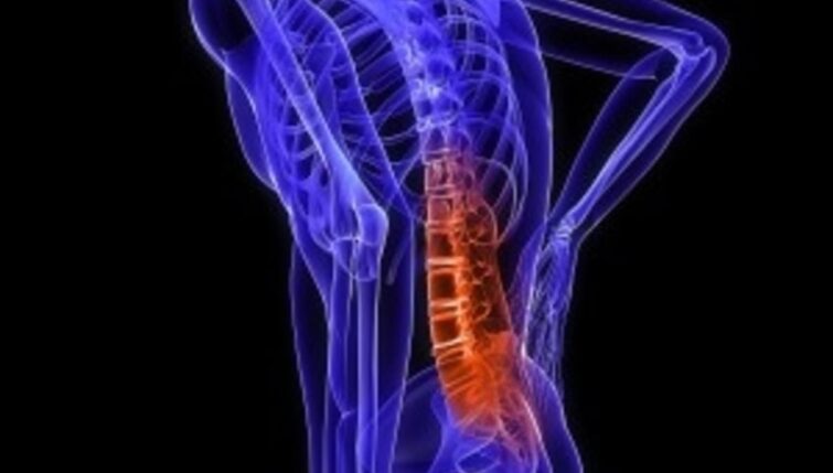 Ankylosing Spondylitis
