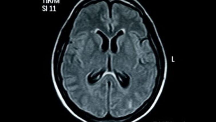 Brain MRI Scan