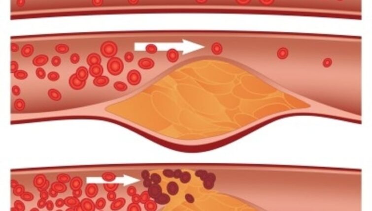 Cholesterol