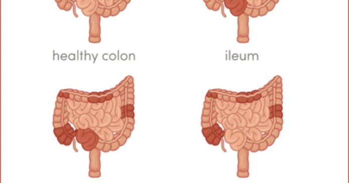 Acupuncture and Chinese herbs can be used for Crohn's disease