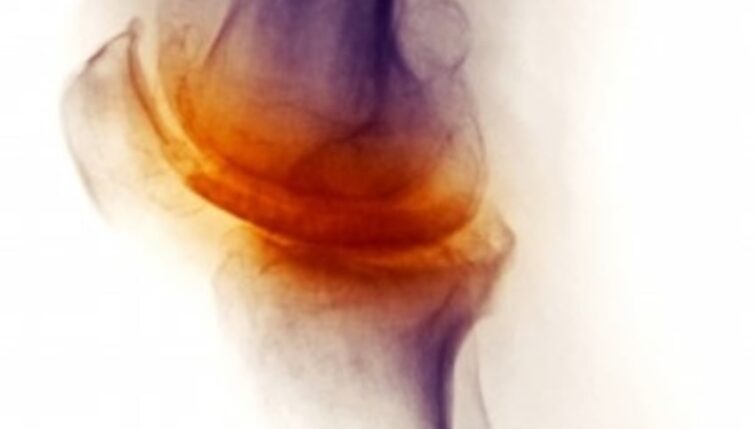 Degenerative Arthritis of Knee