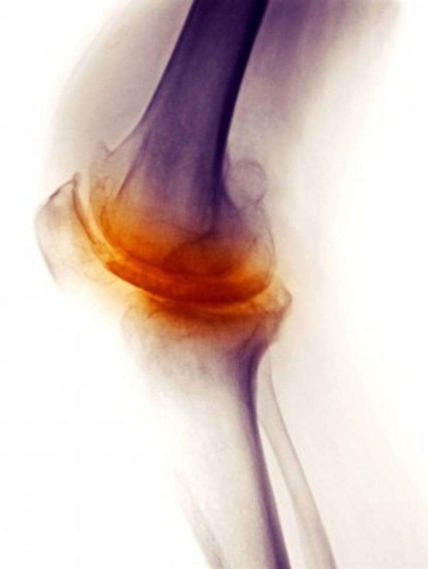 Acupuncture for Osteoarthritis of the Knee The Acupuncture Clinic