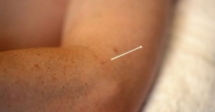 Acupuncture for Shoulder-Hand Syndrome