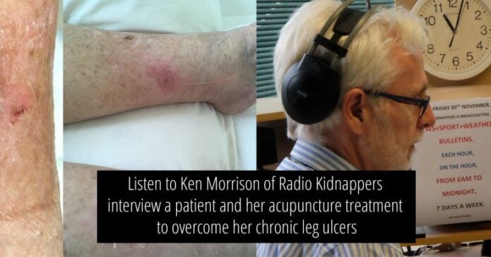 Leg ulcers radio show