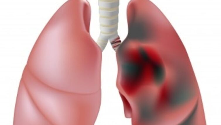 Lung Disease