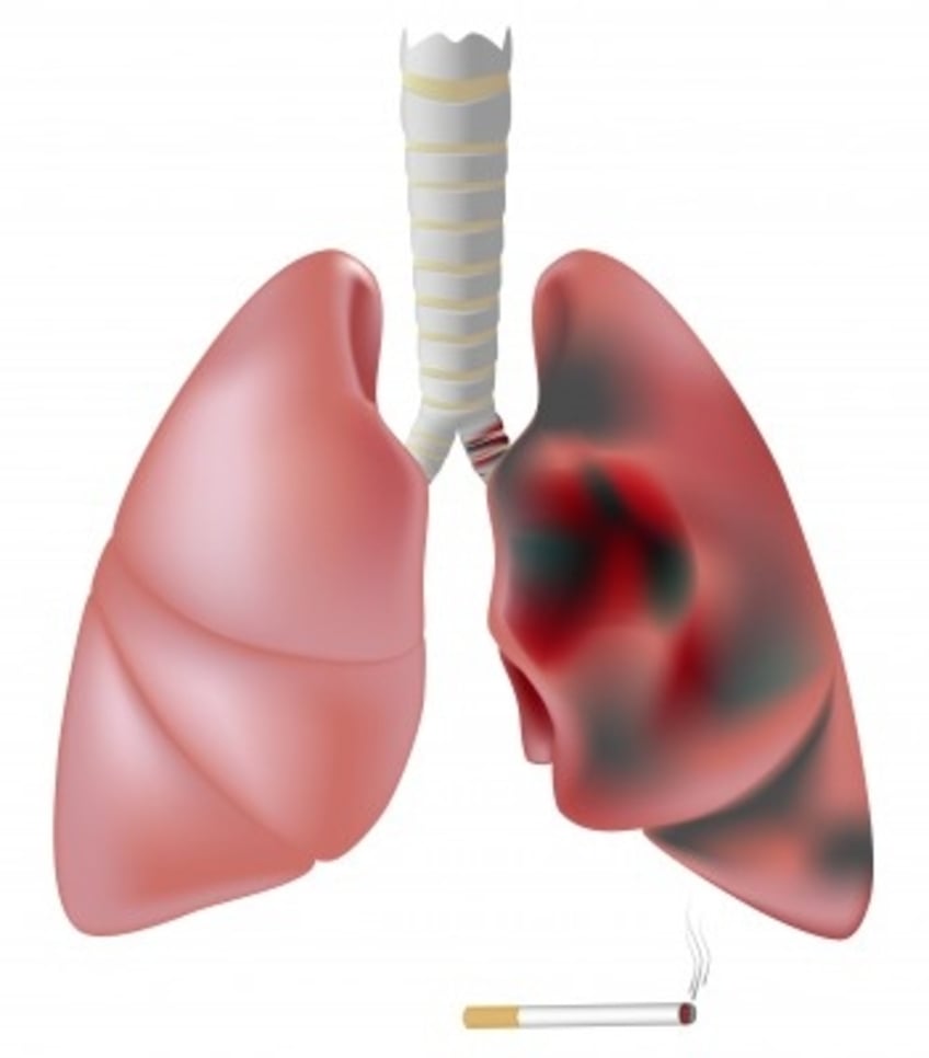 Acupuncture for Lung Disease and COPD The Acupuncture Clinic