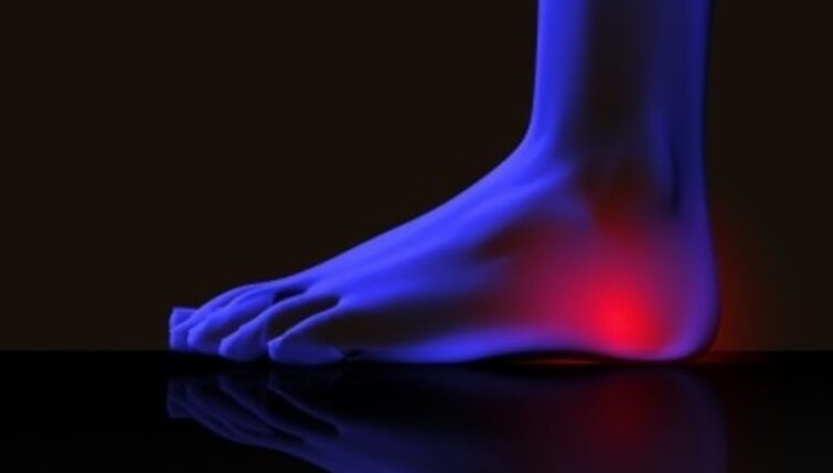 Plantar Fascilitis