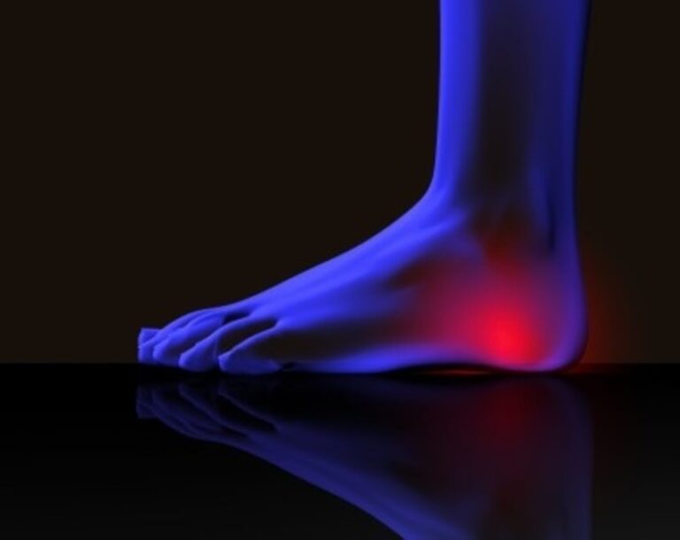 Acupuncture for Plantar Fasciitis The Acupuncture Clinic
