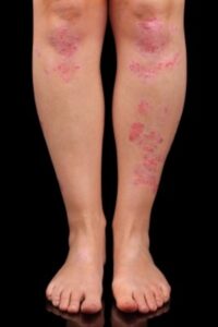 Psoriasis on the Legs