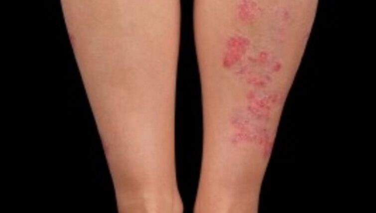 Psoriasis on the Legs