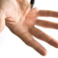 Acupuncture for Dupuytrens Contracture