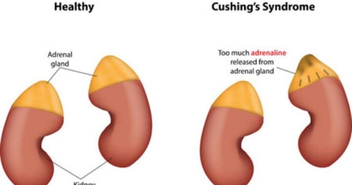 Acupuncture for Cushing's Syndrome