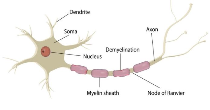 Multiple Sclerosis – Revisited