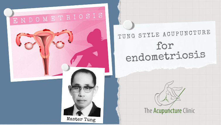 Tung-Style-Acupuncture-for-endometriosis
