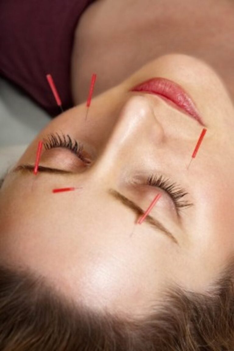 Acupuncture for Sinus The Acupuncture Clinic